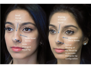 Nose Job Bulbous Tip: Transform Your Nasal Tip with Precision Rhinoplasty