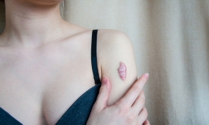 Why Is Keloid Treatment Important?
