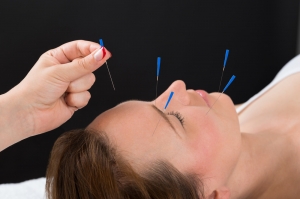 What Are the Benefits of Acupuncture for Migraine Relief?