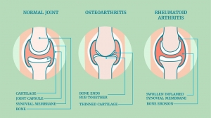 Rheumatoid Arthritis Market Size, Industry Trends, Growth 2024-34