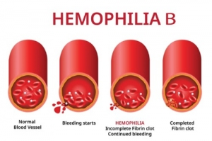 Hemophilia B Market Growth Analysis, Size, Share, Report 2024-34