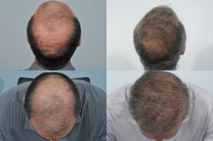 Which Celebrities Have Had Hair Transplants?