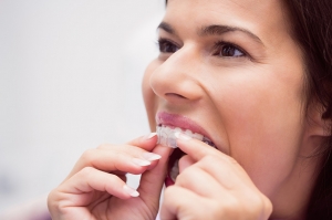 How Aligners Are Helping People Achieve Perfect Smiles Without the Metal