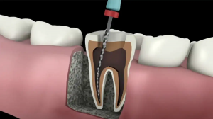 Restore Your Smile with Expert Root Canal Care in Dubai