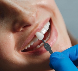 Discover the Benefits of Veneers for Your Smile in Dubai