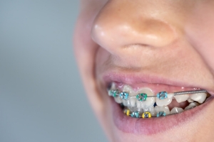 How to Handle Common Challenges When Wearing Braces