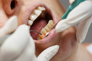 Gum Contouring Solutions for Common Smile Concerns