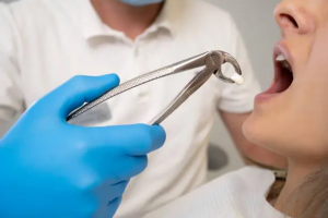 Tooth Removal in Dubai Fast, Safe, and Reliable