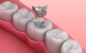 Dubai’s Leading Experts in Tooth Fillings for Optimal Oral Health