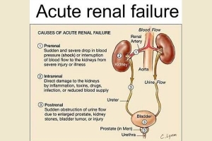 Acute Renal Failure Market Share Analysis, Size, Report 2024-34