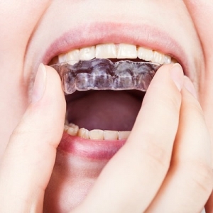 Teeth Protection at Its Best Mouthguards in Dubai