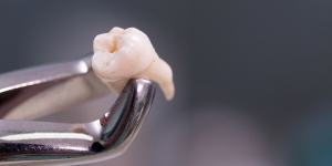 Professional Wisdom Tooth Removal in Dubai for Quick Recovery