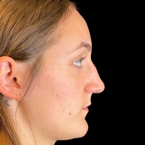 Closed Rhinoplasty  What You Need to Know