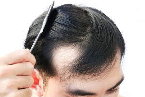 Exploring Contemporary Therapies for Alopecia Areata