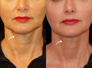 The Long-Lasting Results of Sculptra Fillers Treatment in Dubai