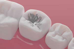 Expert Amalgam Removal at SMART Dental in Dubai