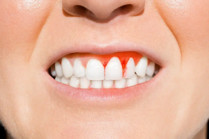 Get Even-Toned Gums with Gum Depigmentation in Dubai