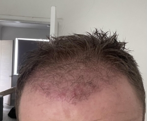 Common Myths About Hair Transplants 