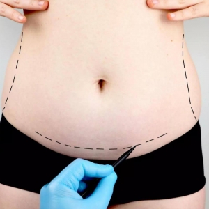Uncovering the Secrets of Tummy Tuck