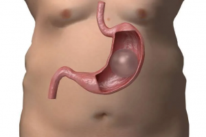 What Should You Expect with a Gastric Balloon?