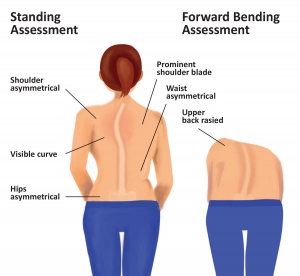 Scoliosis Market Size, Industry Trends, Growth 2024-34