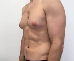 Enhance Your Chest Definition with Gynecomastia Surgery