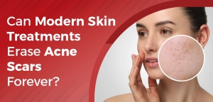 Can Modern Skin Treatments Erase Acne Scars Forever?