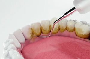 Keep Your Smile Bright Teeth Polishing & Scaling in Dubai
