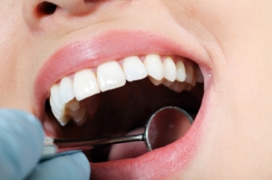 Perfect Your Gum Shape with Gingivectomy in Dubai