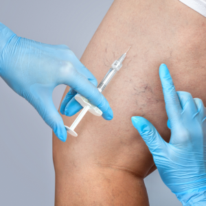 Reasons to Consider Sclerotherapy 