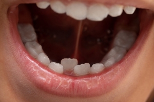 Customized Treatments for Overlapping Teeth in Dubai