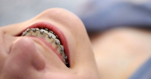 How to Speed Up Your Braces Treatment Without Sacrificing Results