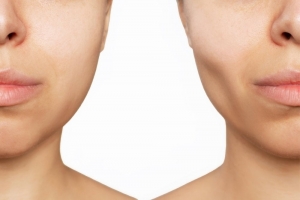 Understanding the Procedure: How Surgery for Face Fat Removal Works