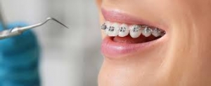How Braces Help Correct Bite Problems and Improve Oral Health