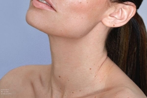 Sculpted Neckline with a Neck Lift Surgery