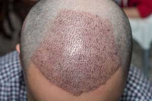 Is it painful to get a hair transplant?