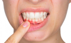 How Do Dentists Treat Chipped Teeth?
