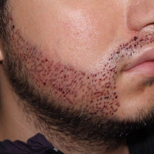Advanced Beard Hair Transplant Technique