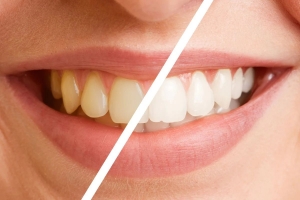 Maintaining a Brilliant Smile After Teeth Whitening