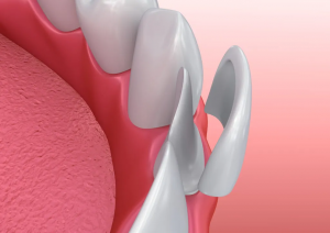 Make Your Smile Shine with Veneers in Dubai