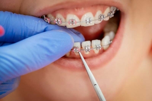 Self-Ligating Braces: A Faster Path to a Straighter Smile?