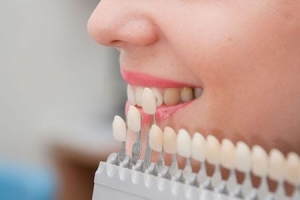 Composite Veneers The Secret to a Radiant Smile in Dubai