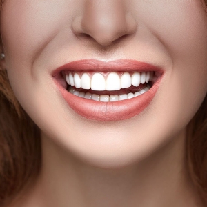 E-max Veneers in Dubai The Future of Smile Design
