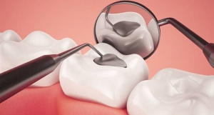 SMART Amalgam Removal Protect Your Health and Smile