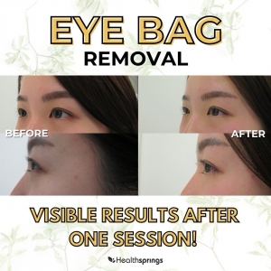 Non-Surgical Eye Bag Removal In Singapore