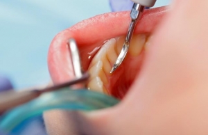 Tooth Fillings A Simple Solution to Tooth Decay