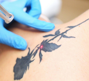 Laser Tattoo Removal for Colorful Tattoos: What to Expect in Dubai
