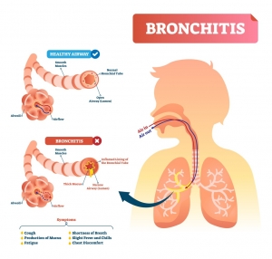 Bronchitis Market Growth Analysis, Trends, Report 2024-34