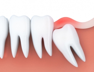 Everything You Should Know Before Getting Your Wisdom Teeth Out