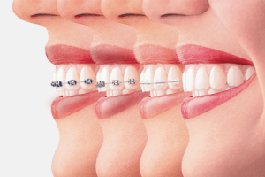 Stylish and Comfortable Dental Retainers Available in Dubai